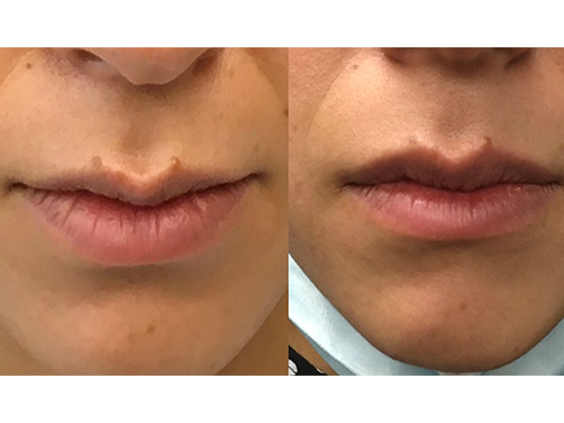 lip flip washington d.c. Treiber Dermatology Associates